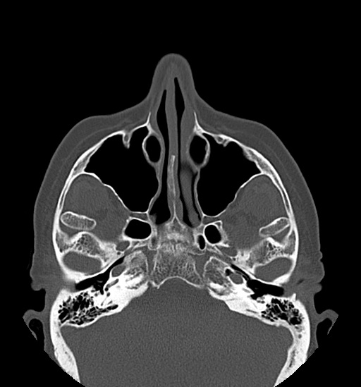 Anterior temporomandibular joint dislocation (Radiopaedia 59430-66784 Axial non-contrast 13).jpg