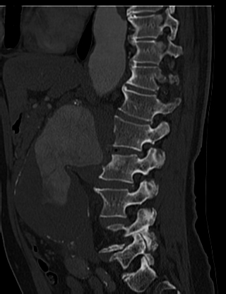 File:Anterior vertebral scalloping (abdominal aortic aneurysm) (Radiopaedia 66744-76067 Sagittal bone window 18).jpg