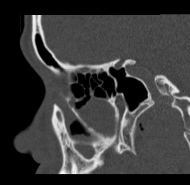 Antrochoanal polyp (Radiopaedia 33984-35202 Sagittal bone window 29).jpg