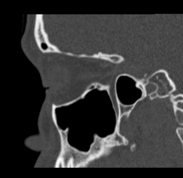 Antrochoanal polyp (Radiopaedia 33984-35202 Sagittal bone window 57).jpg