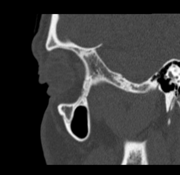 Antrochoanal polyp (Radiopaedia 33984-35202 Sagittal bone window 75).jpg