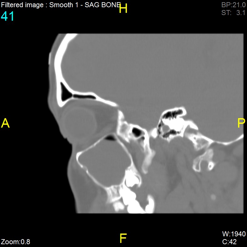Antrochoanal polyp (Radiopaedia 65101-74094 Sagittal bone window 41).jpg