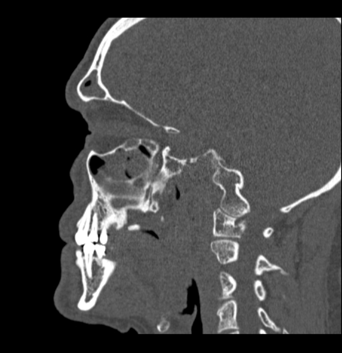 Antrochoanal polyp (Radiopaedia 79011-92169 Sagittal bone window 13).jpg