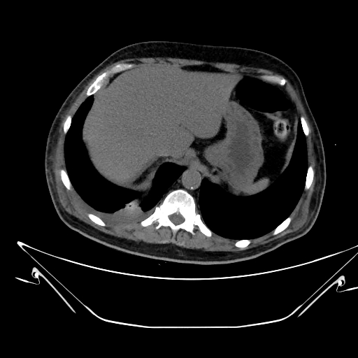 Aortic arch aneurysm (Radiopaedia 84109-99365 Axial non-contrast 254).jpg