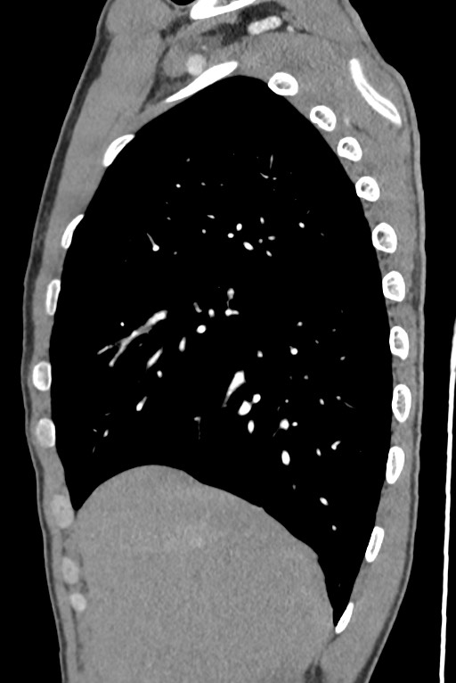 Aortic coarctation with aneurysm (Radiopaedia 74818-85828 B 43).jpg