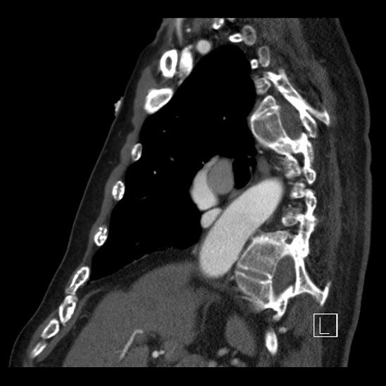 File:Aortic dissection (CTPA) (Radiopaedia 75506-86750 C 42).jpg