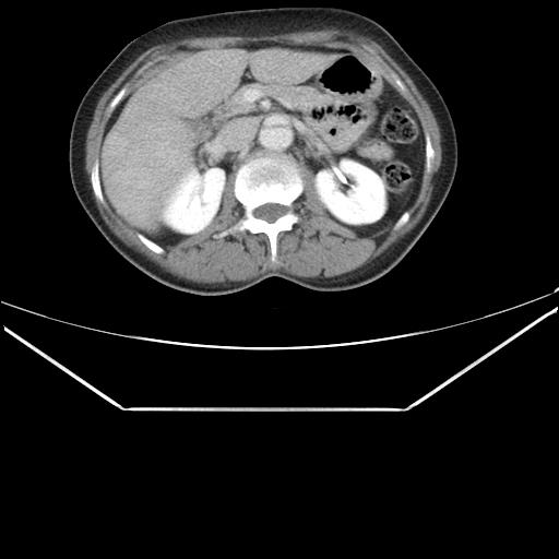 File:Aortic dissection (Radiopaedia 25350-25604 C 58).jpg