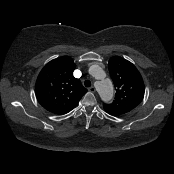 Aortic dissection (Radiopaedia 57969-64959 A 86).jpg
