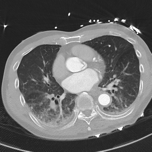 File:Aortic dissection - DeBakey type II (Radiopaedia 64302-73082 Axial lung window 37).png