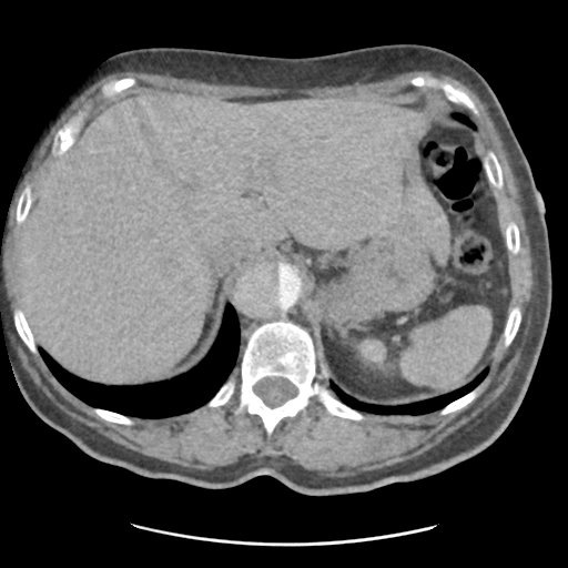 File:Aortic dissection - Stanford type B (Radiopaedia 50171-55512 A 46).png