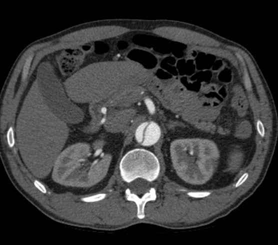 Aortic dissection - Stanford type B (Radiopaedia 73648-84437 A 134).jpg