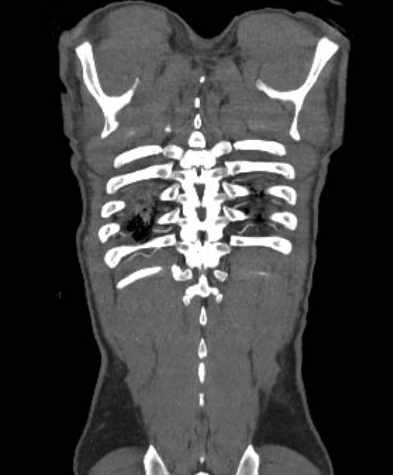 File:Aortic dissection - Stanford type B (Radiopaedia 73648-84437 B 108).jpg