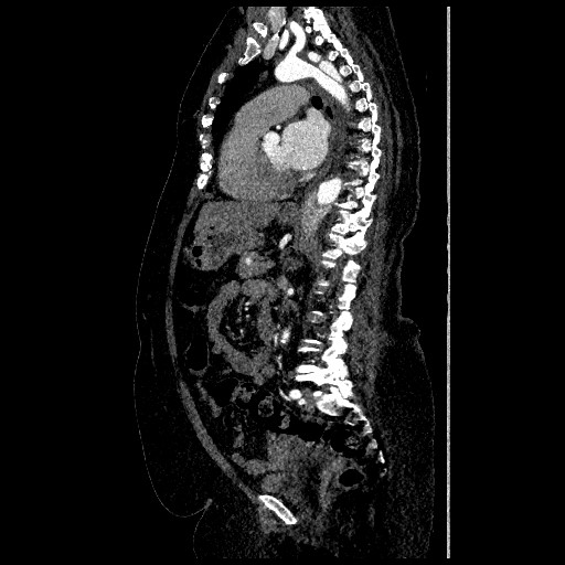 File:Aortic dissection - Stanford type B (Radiopaedia 88281-104910 C 46).jpg