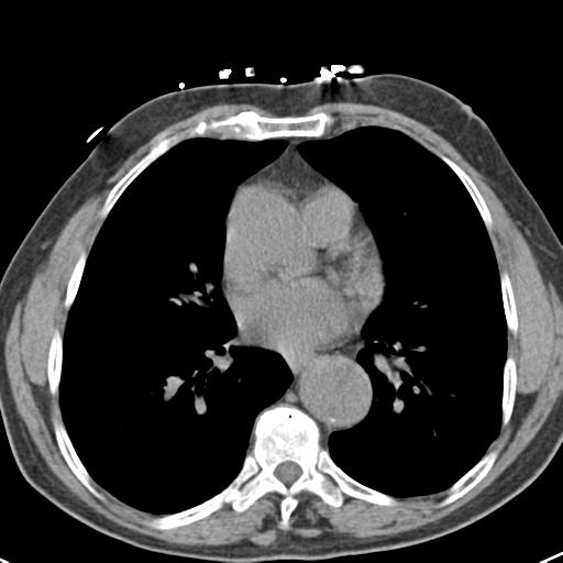 Aortic intramural hematoma (Radiopaedia 31139-31838 Axial non-contrast 32).jpg