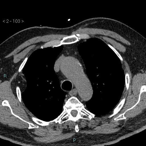 Aortic intramural hematoma (Radiopaedia 48463-53380 Axial non-contrast 45).jpg