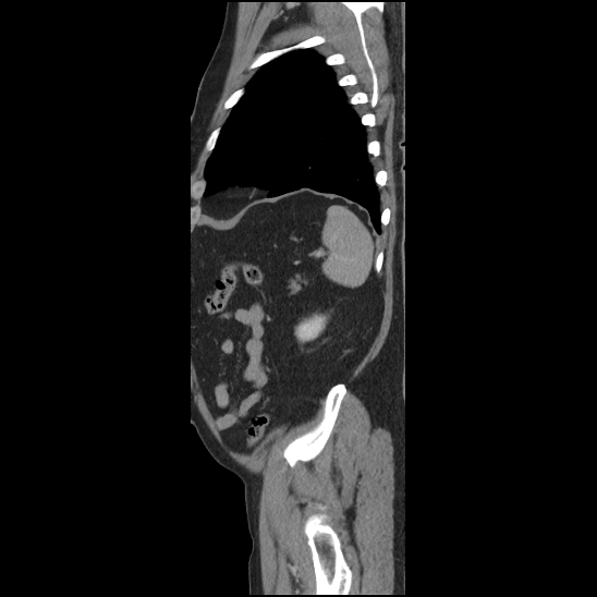 Aortic intramural hematoma (type B) (Radiopaedia 79323-92387 Sagittal C+ delayed 48).jpg