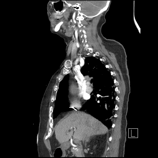 Aortic intramural hematoma with dissection and intramural blood pool (Radiopaedia 77373-89491 D 33).jpg