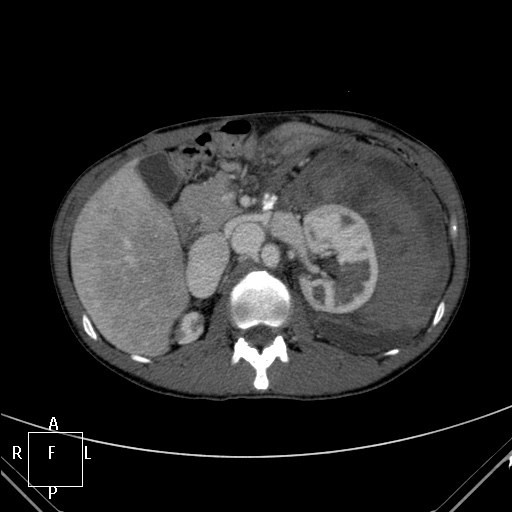 File:Aorto-left renal vein fistula (Radiopaedia 45534-49628 A 17).jpg