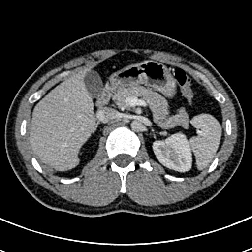 Apical lung mass mimic - neurogenic tumor (Radiopaedia 59918-67521 A 89).jpg