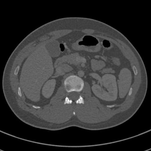 File:Apical lung mass mimic - neurogenic tumor (Radiopaedia 59918-67521 Axial bone window 93).jpg