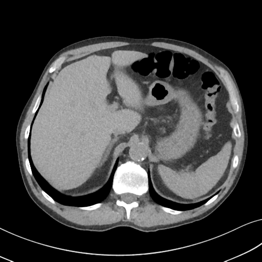 Apical pulmonary metastasis (Radiopaedia 46338-50754 B 60).png