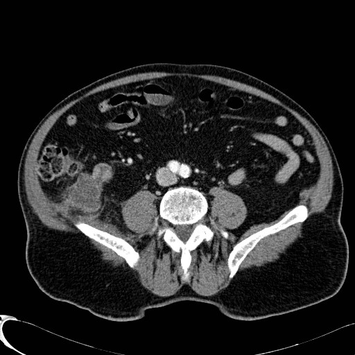 File:Appendiceal adenocarcinoma complicated by retroperitoneal abscess (Radiopaedia 58007-65040 Axial 1).jpg