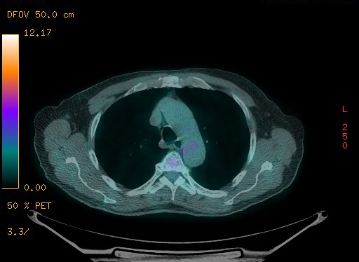Appendiceal adenocarcinoma complicated by retroperitoneal abscess (Radiopaedia 58007-65041 Axial PET-CT 52).jpg