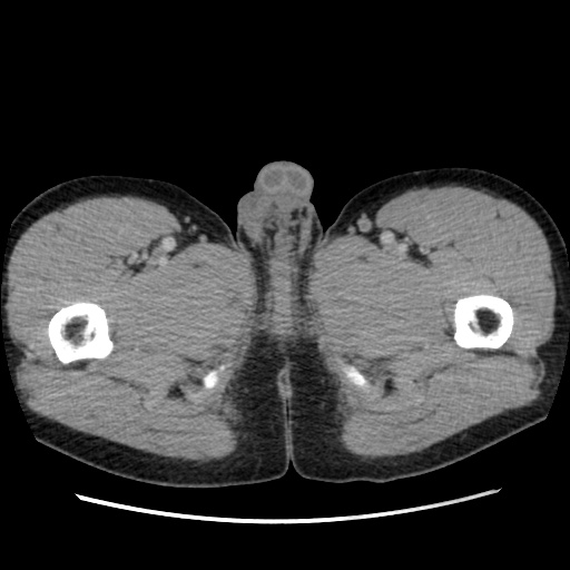 File:Appendicitis complicated by post-operative collection (Radiopaedia 35595-37114 A 98).jpg