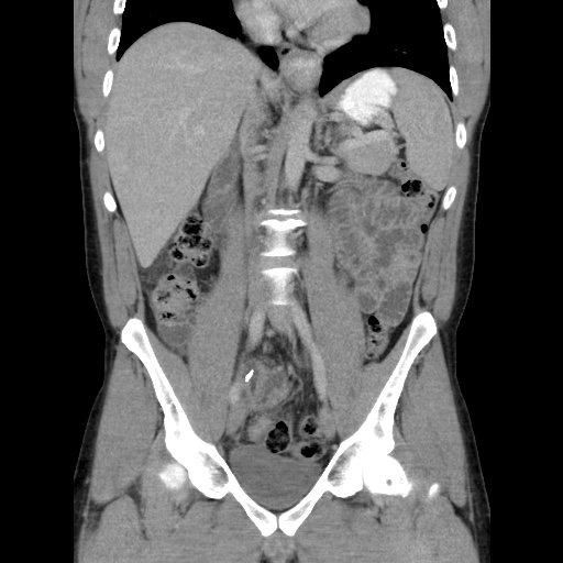 Appendicitis complicated by post-operative collection (Radiopaedia 35595-37114 B 29).jpg