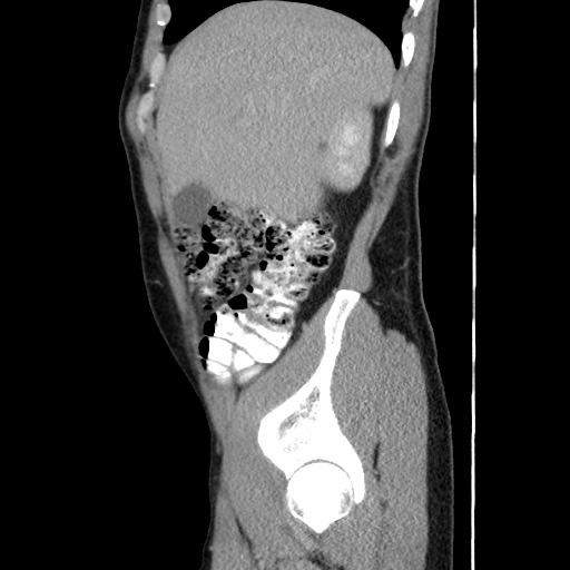 Appendicitis complicated by post-operative collection (Radiopaedia 35595-37114 C 20).jpg