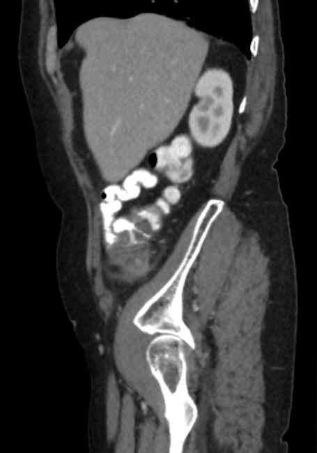 Appendicitis due to chicken fibula (Radiopaedia 74314-85198 C 20).jpg