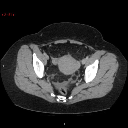 File:Appendicitis with microperforation- promontoric type (Radiopaedia 27268-27442 C 69).jpg