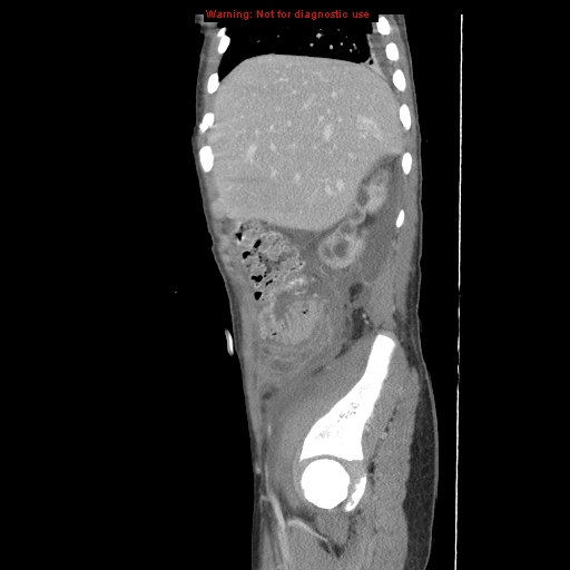 File:Appendicitis with phlegmon (Radiopaedia 9358-10046 F 8).jpg