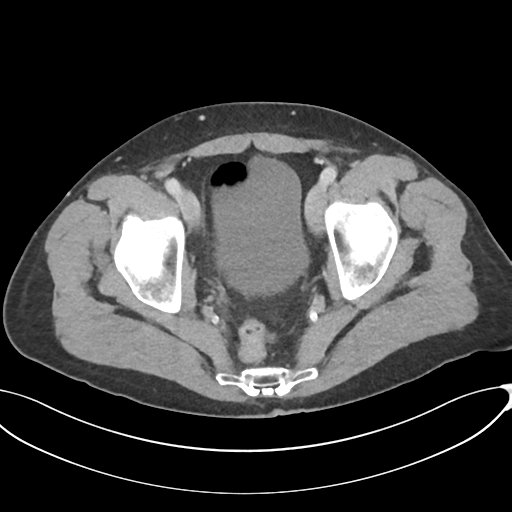 Appendicitis with thickening of the terminal ileum (Radiopaedia 42432-45550 A 86).png