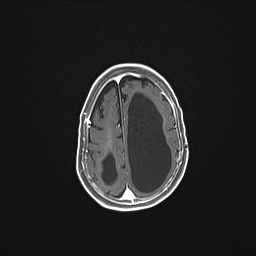 Aqueductal stenosis (Radiopaedia 73974-84802 Axial T1 C+ 123).jpg