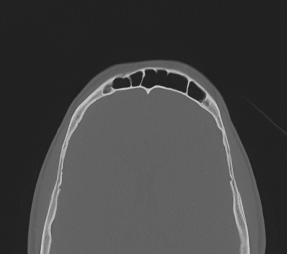 File:Arachnoid cyst - cerebellopontine angle (Radiopaedia 59689-67082 Axial bone window 39).png