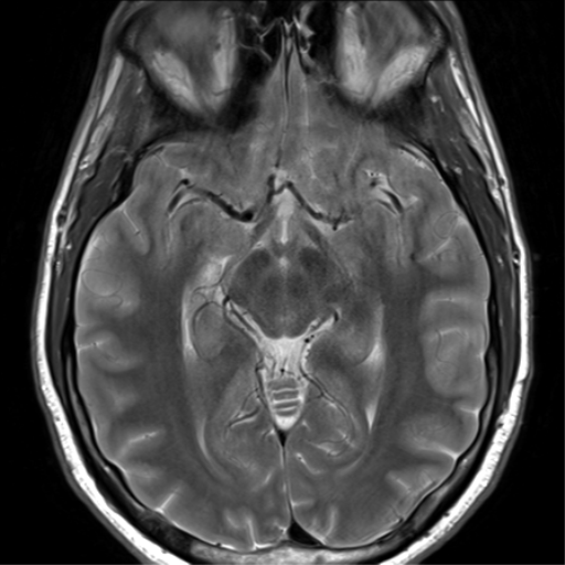 File:Arachnoid cyst - cerebellopontine angle (Radiopaedia 59689-67083 Axial T2 23).png