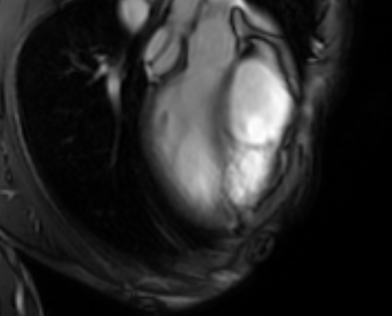 Arrhythmogenic right ventricular cardiomyopathy (Radiopaedia 69564-79464 4ch cine 16).jpg