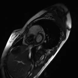 Arrhythmogenic right ventricular cardiomyopathy (Radiopaedia 87505-103850 short axis Cine SSFP 232).jpg