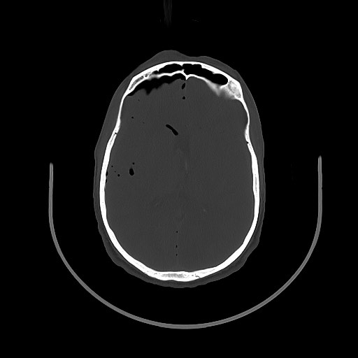File:Arrow injury to the brain (Radiopaedia 72101-82607 Axial 139).jpg