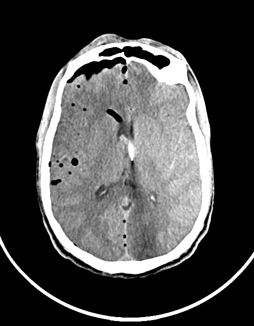 Arrow injury to the brain (Radiopaedia 72101-82607 Axial non-contrast 72).jpg