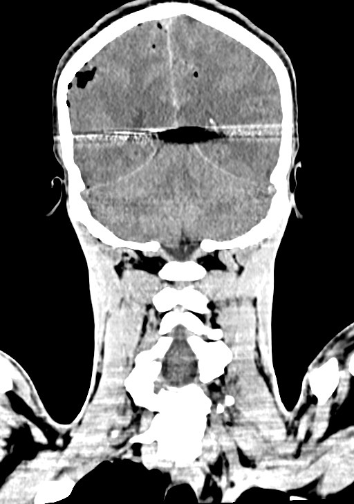 Arrow injury to the brain (Radiopaedia 72101-82607 Coronal non-contrast 53).jpg