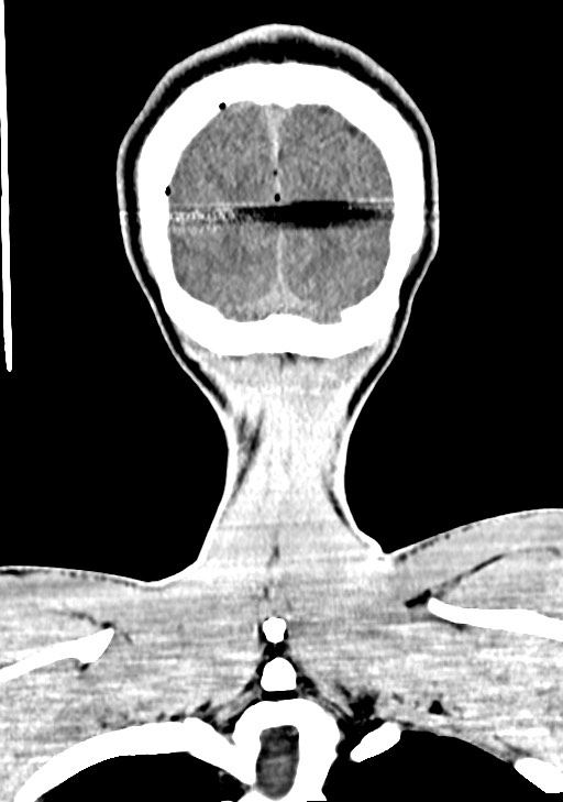 Arrow injury to the brain (Radiopaedia 72101-82607 Coronal non-contrast 65).jpg
