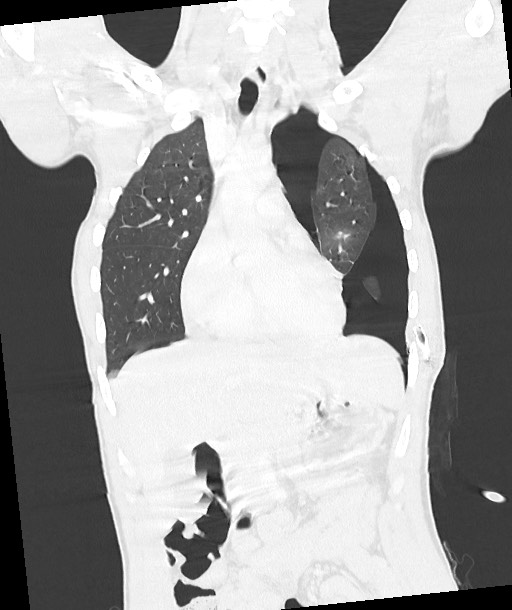Arrow injury to the chest (Radiopaedia 85367-100975 Coronal lung window 63).jpg