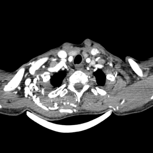 Arteriovenous malformation of the neck (Radiopaedia 53935-60062 A 4).jpg