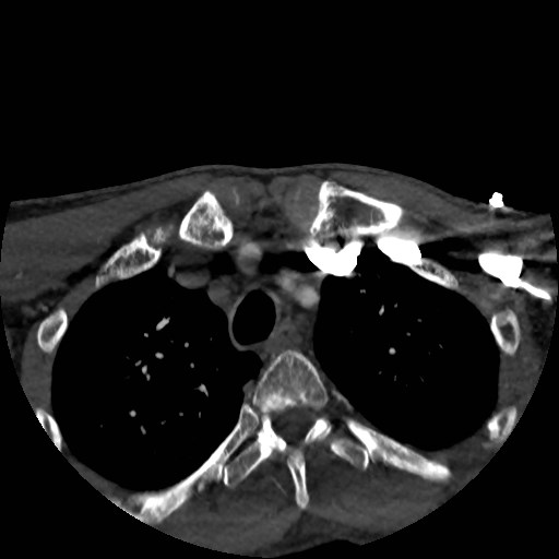 Artery of Percheron infarct (Radiopaedia 48088-52894 A 15).jpg