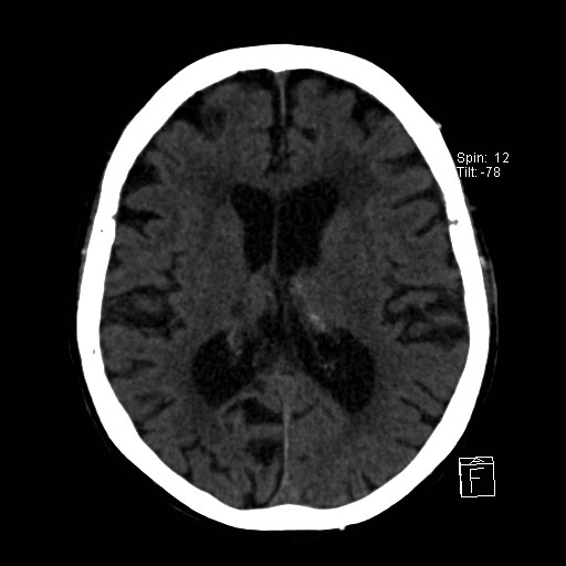 File:Artery of Percheron infarction (Radiopaedia 26307-26439 Axial non-contrast 26).jpg