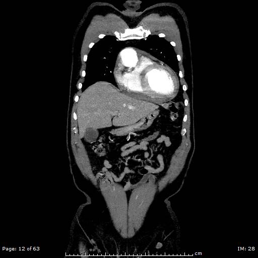 File:Ascending aortic aneurysm (Radiopaedia 50086-55404 B 12).jpg