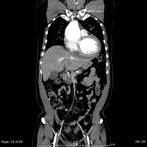 File:Ascending aortic aneurysm (Radiopaedia 50086-55404 B 19).jpg