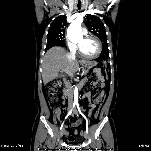File:Ascending aortic aneurysm (Radiopaedia 50086-55404 B 27).jpg